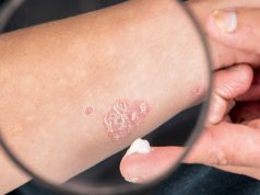 Od veljače se diljem Hrvatske organiziraju edukativne radionice za oboljele od psorijaze